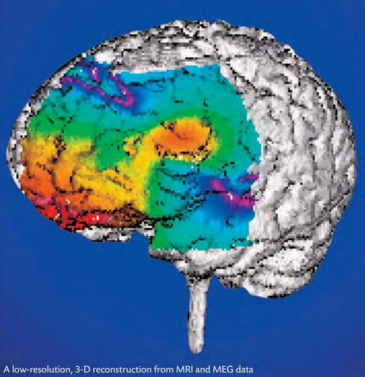 Abnormal neuronal firing causes intense electrical activity of frontal lobe epilepsy.