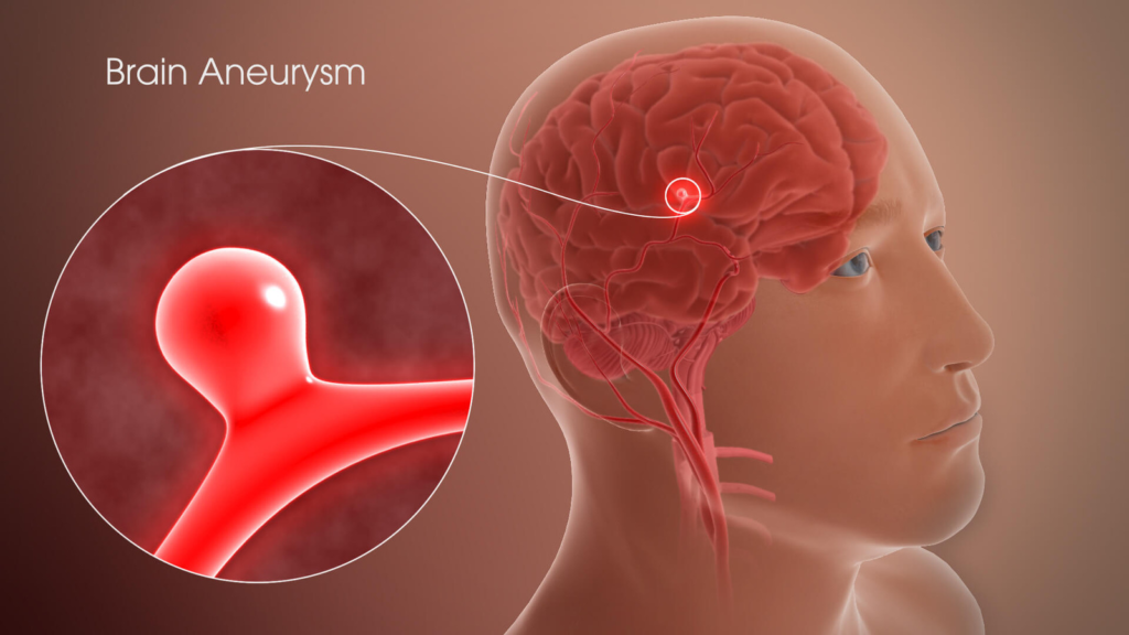 Unraveling the Mystery of Brain Aneurysms: Understanding, Prevention, and Treatment