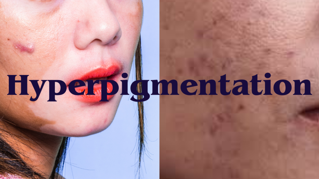 Understanding and Managing Hyperpigmentation