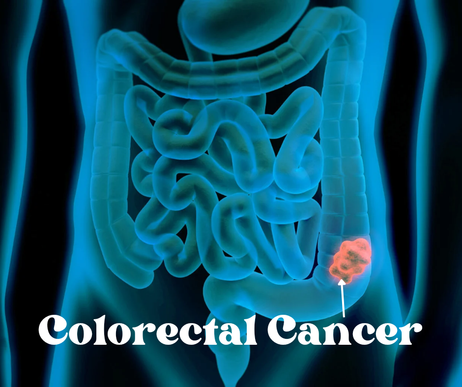 Colorectal Cancer