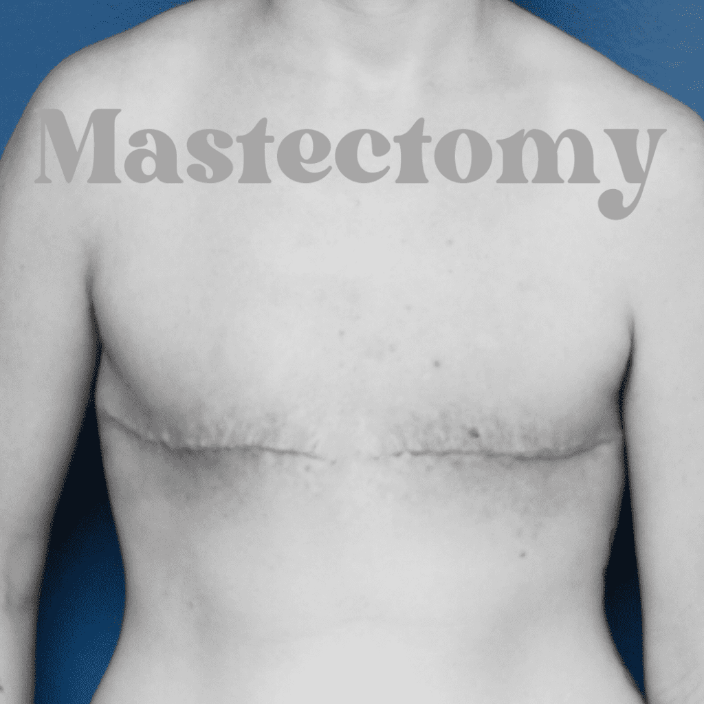 Mastectomy