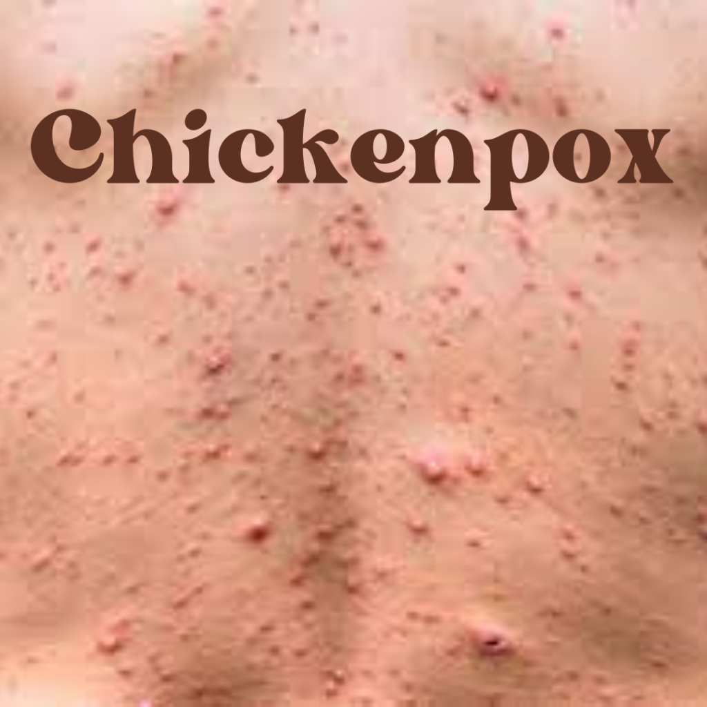 Chickenpox: Symptoms, Treatment, and Prevention