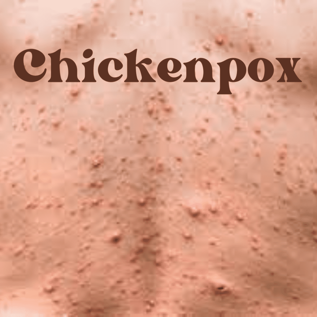 Understanding Chickenpox