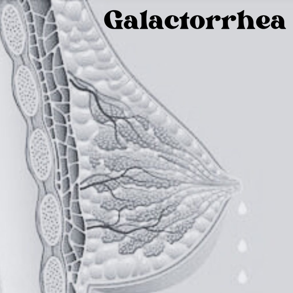 Galactorrhea Condition