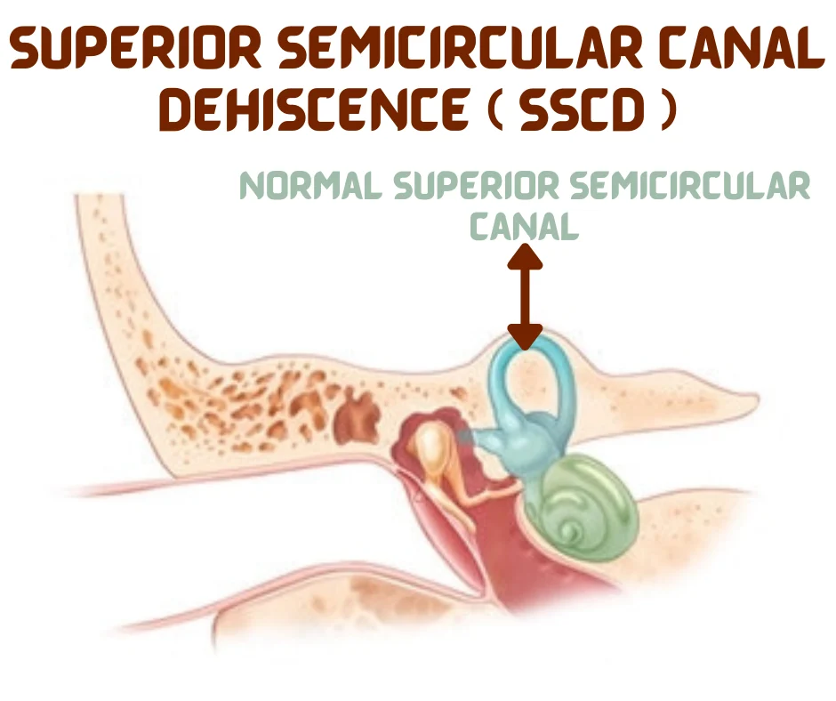 7 Facts Of Superior Semicircular Canal Dehiscence