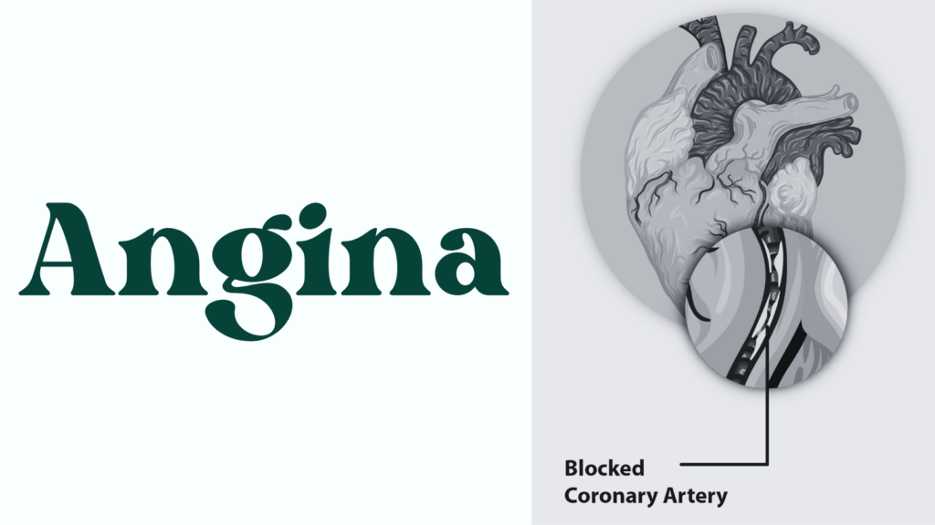 Angina: Symptoms, Causes, and Treatment