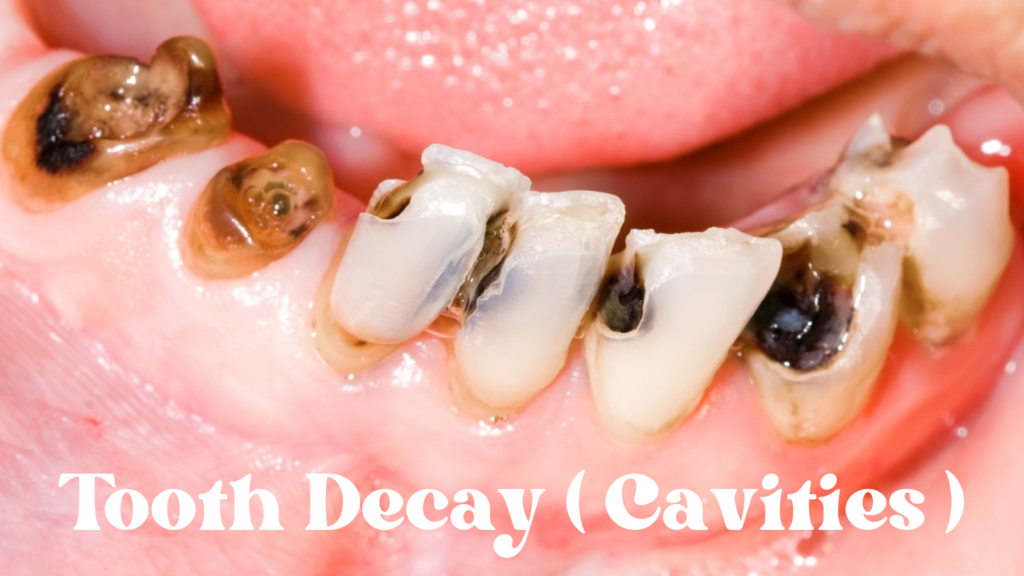 Tooth Decay ( Cavities )