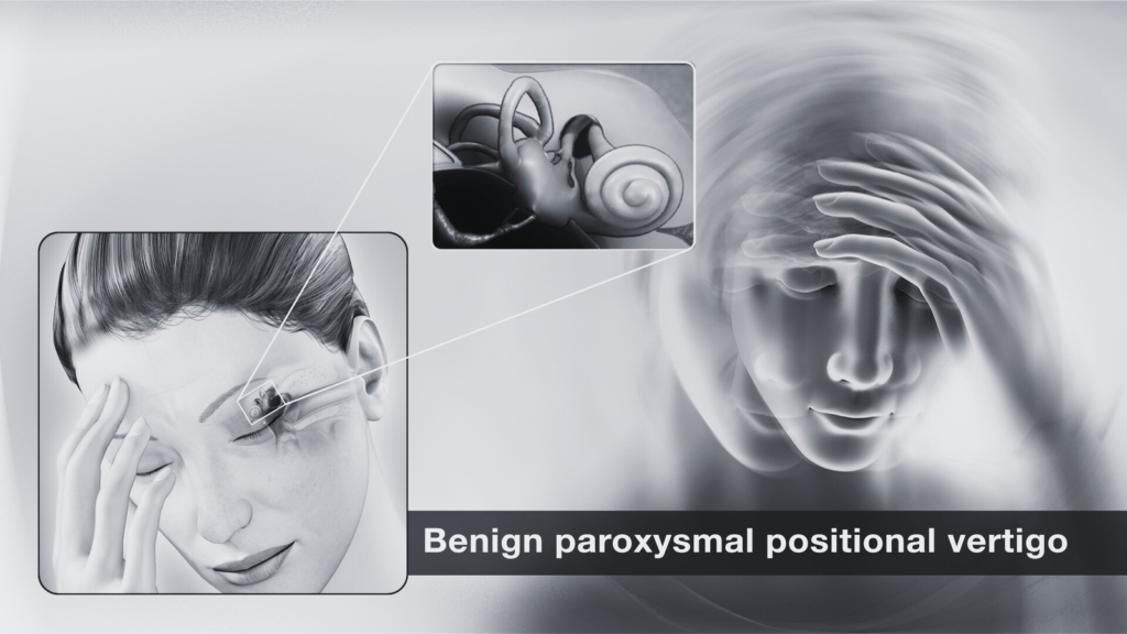 Benign Paroxysmal Positional Vertigo ( BPPV )