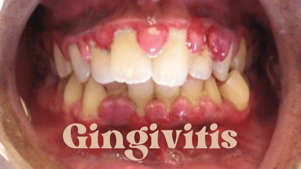 Gingivitis Symptoms