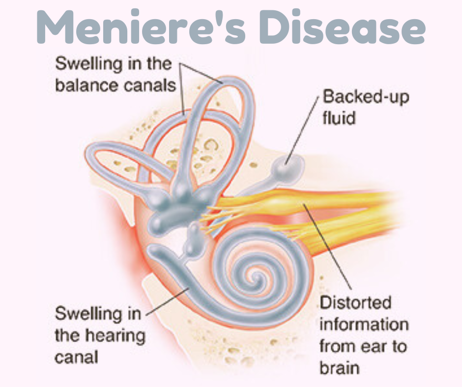Meniere's Disease: Symptoms, Causes, Diagnosis, and Treatment