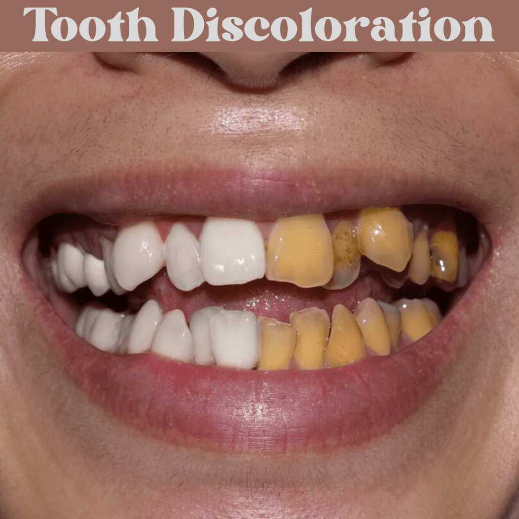 Tooth Discoloration