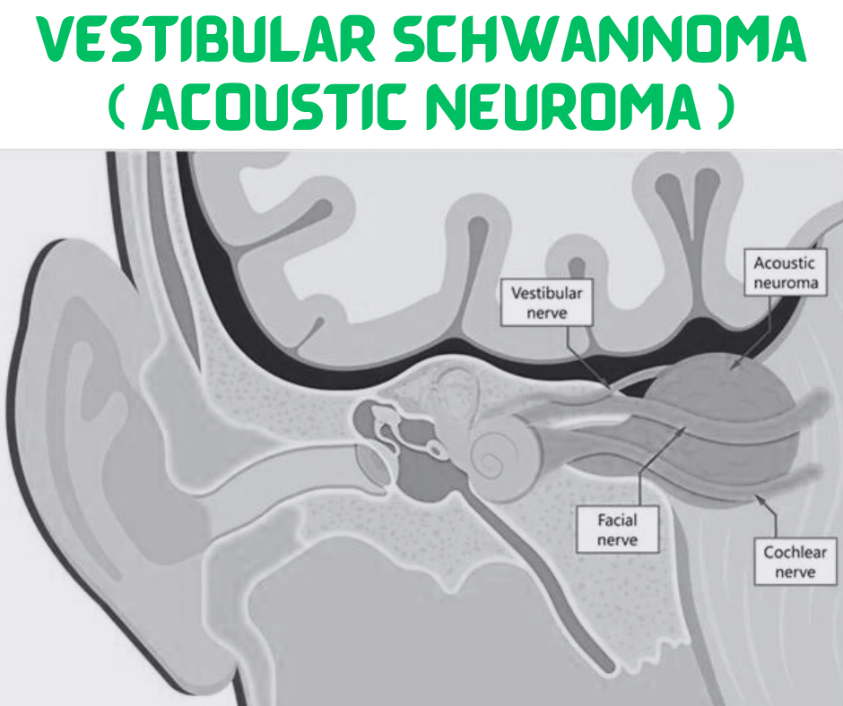Vestibular Schwannoma ( Acoustic Neuroma )