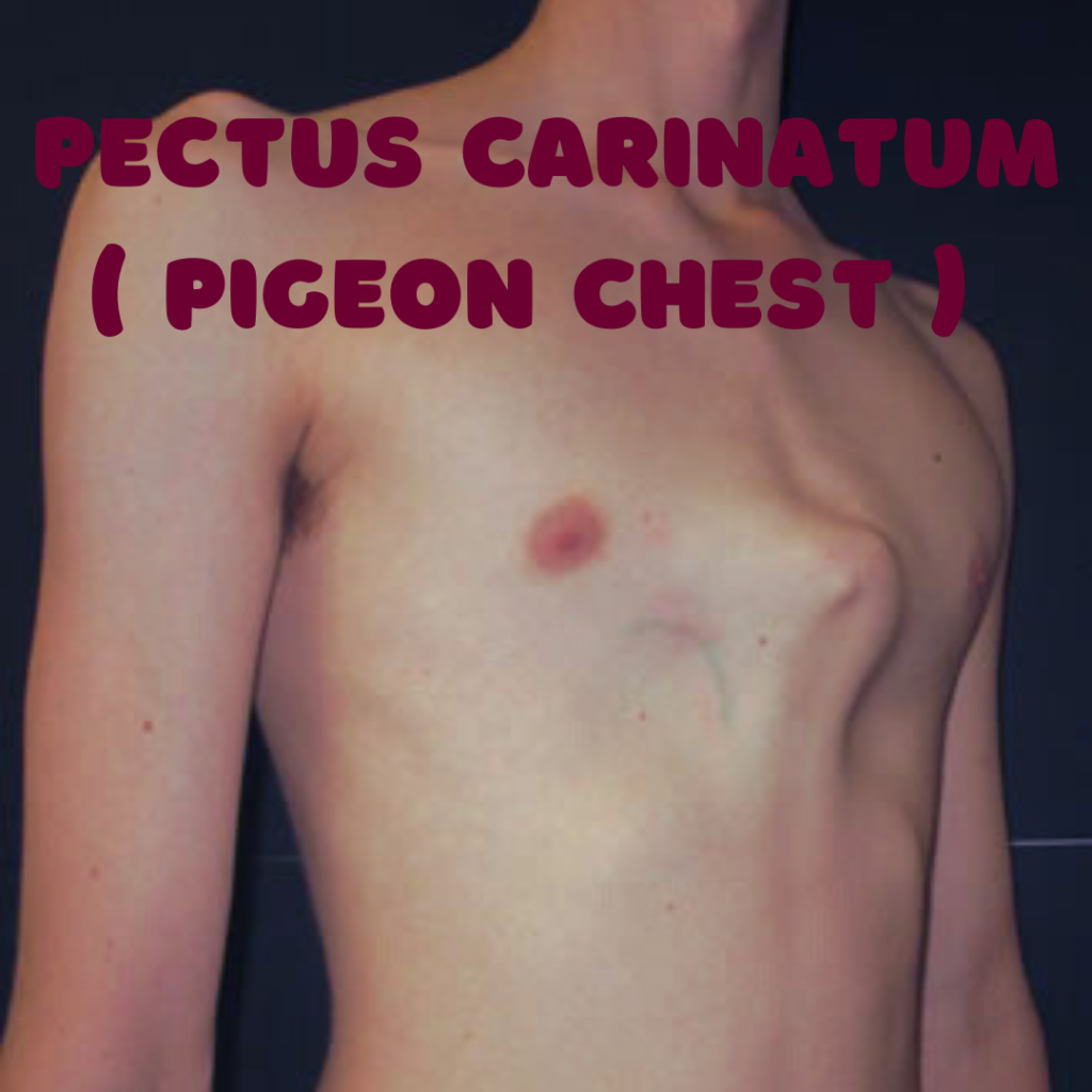 Pectus Carinatum ( Pigeon Chest )