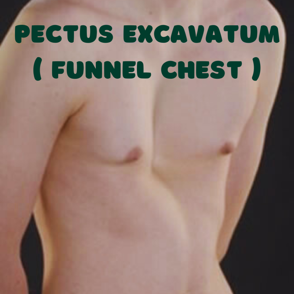 Pectus Excavatum ( Funnel Chest ) 