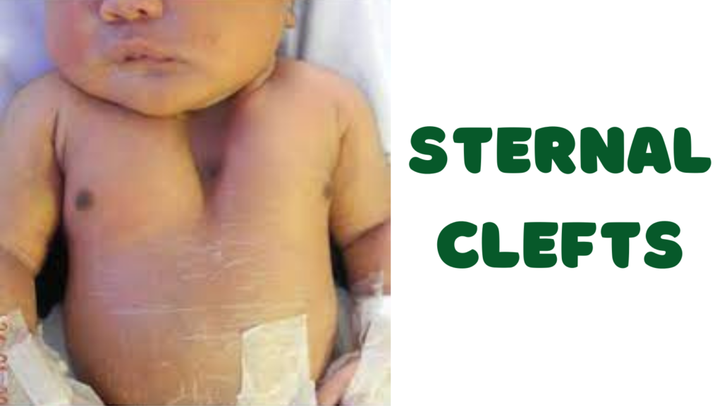 Sternal Clefts
