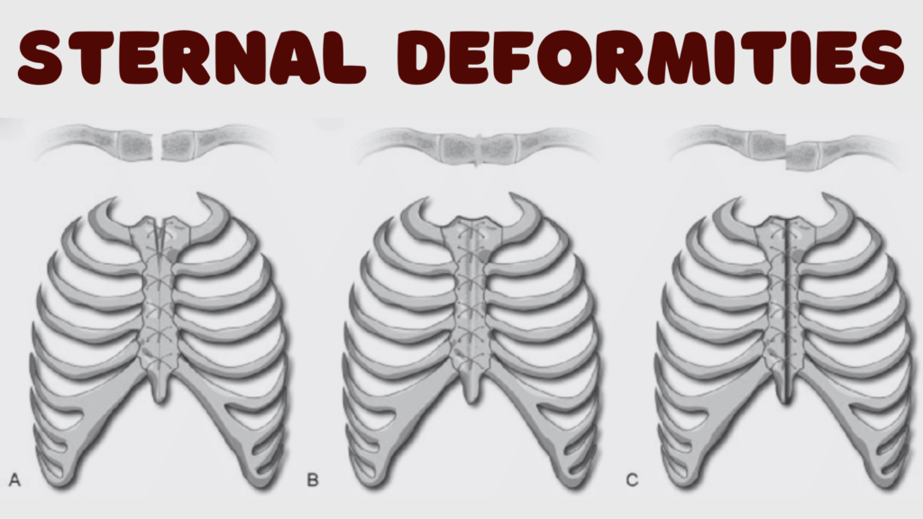 Sternal Deformities