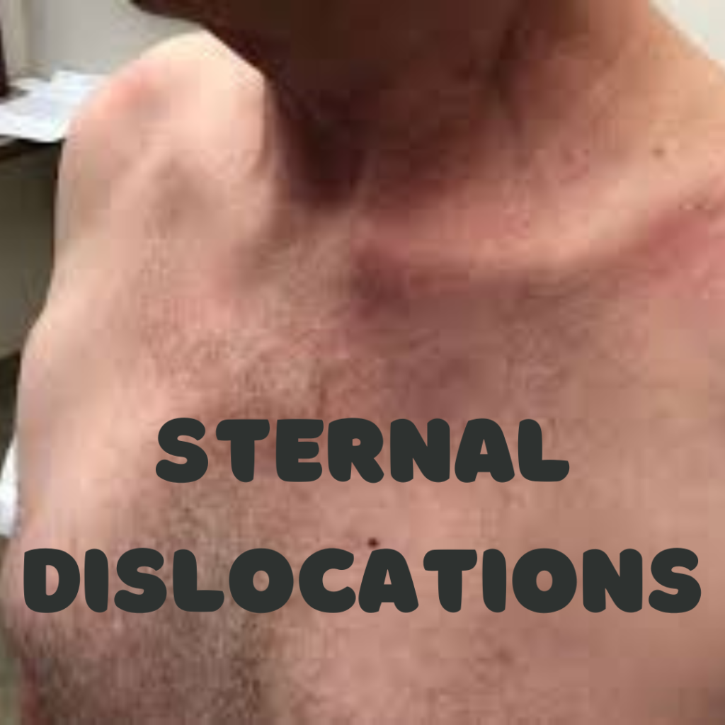 Sternal Dislocations