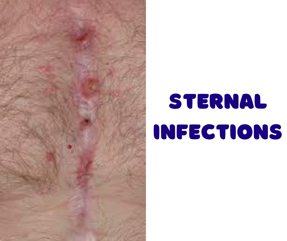 Sternal Infections