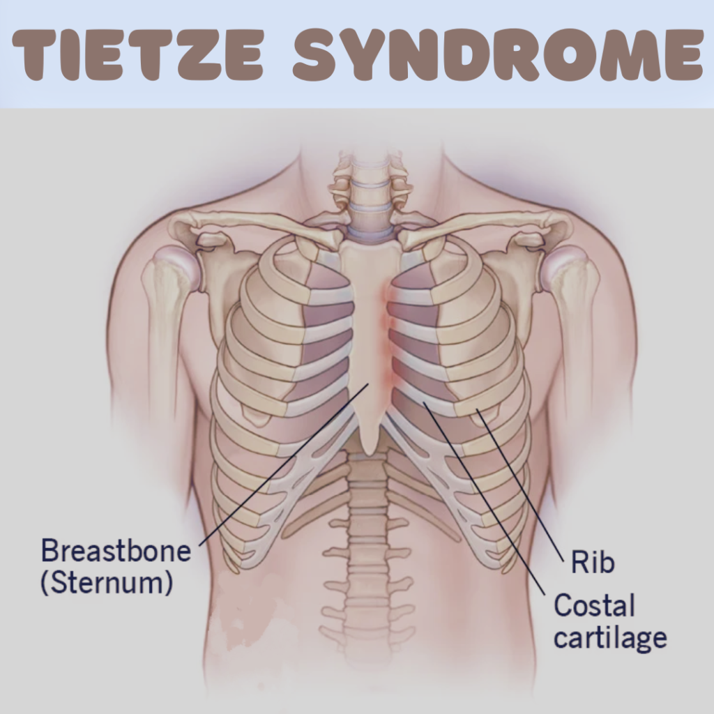 Tietze Syndrome