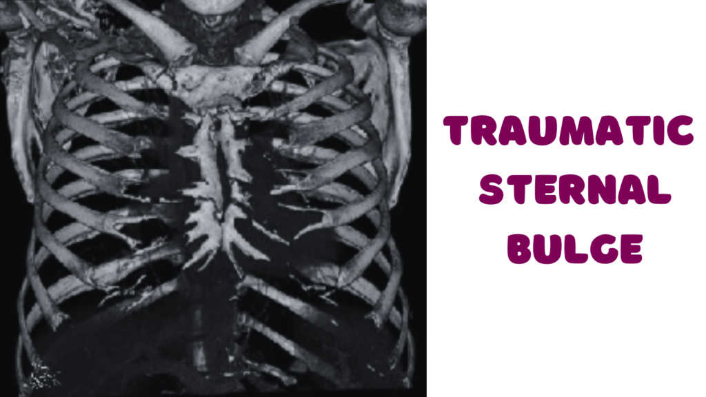 Traumatic Sternal Bulge